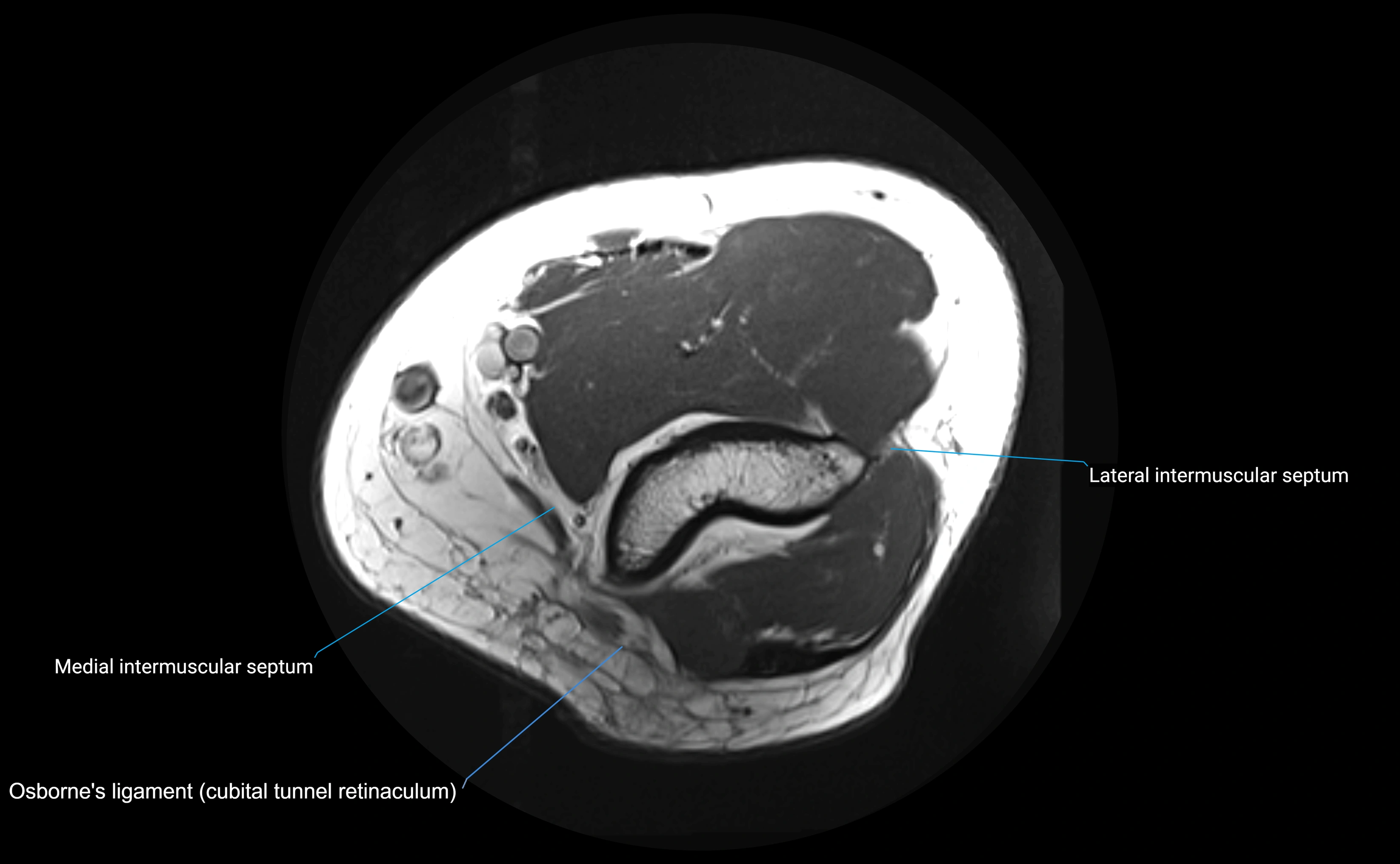 MRI elbow ligaments axial cross sectional anatomy 3T  radiology  image-img-00001-00007.webp
